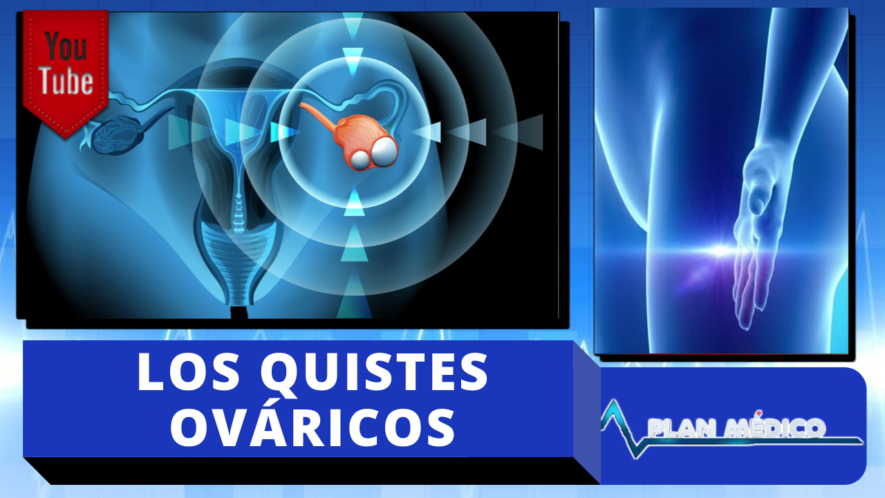 Causas, Síntomas Y Tratamientos De Los Quistes Ováricos | Plan Médico
