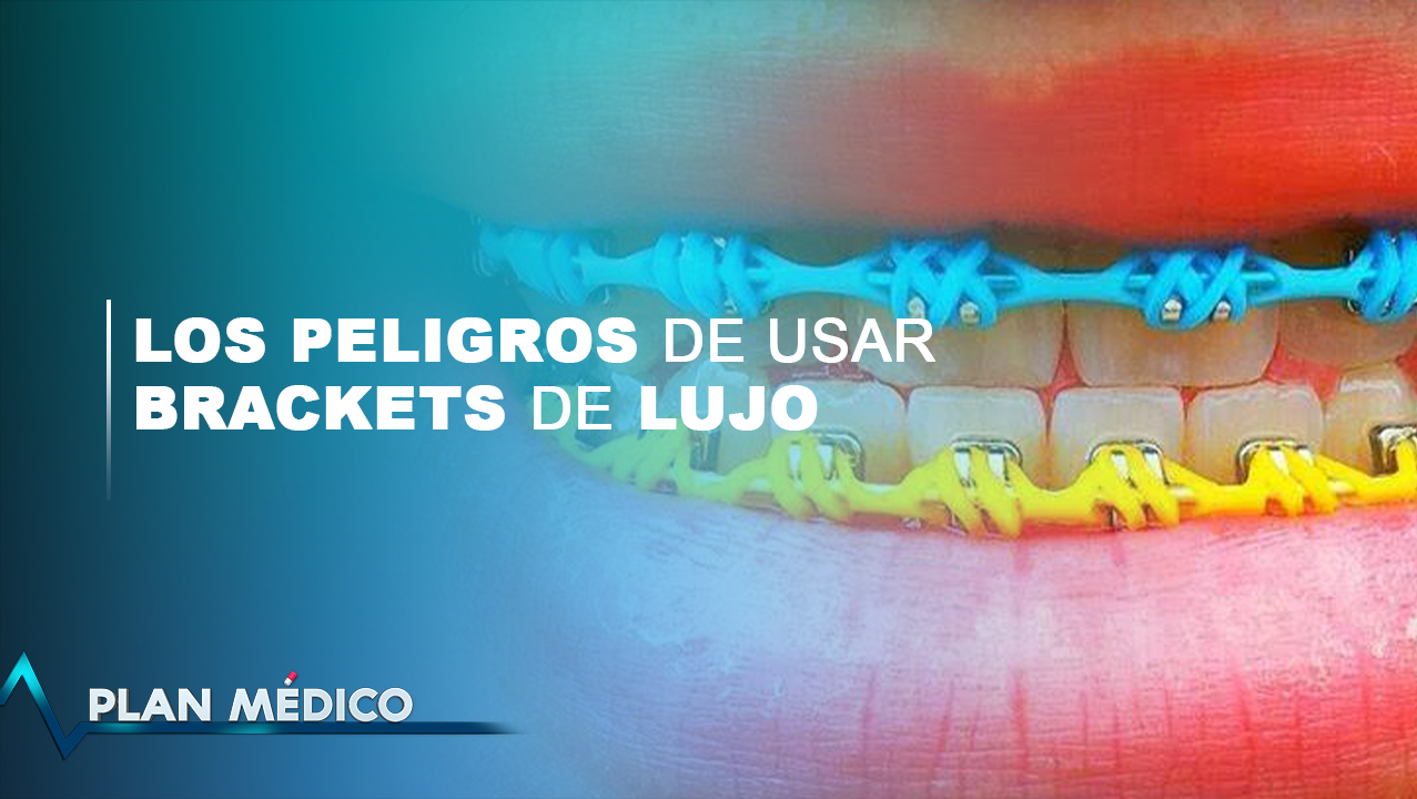 EN VIVO: Los Grandes Peligros De Usar Brackets De Lujo | Plan Médico
