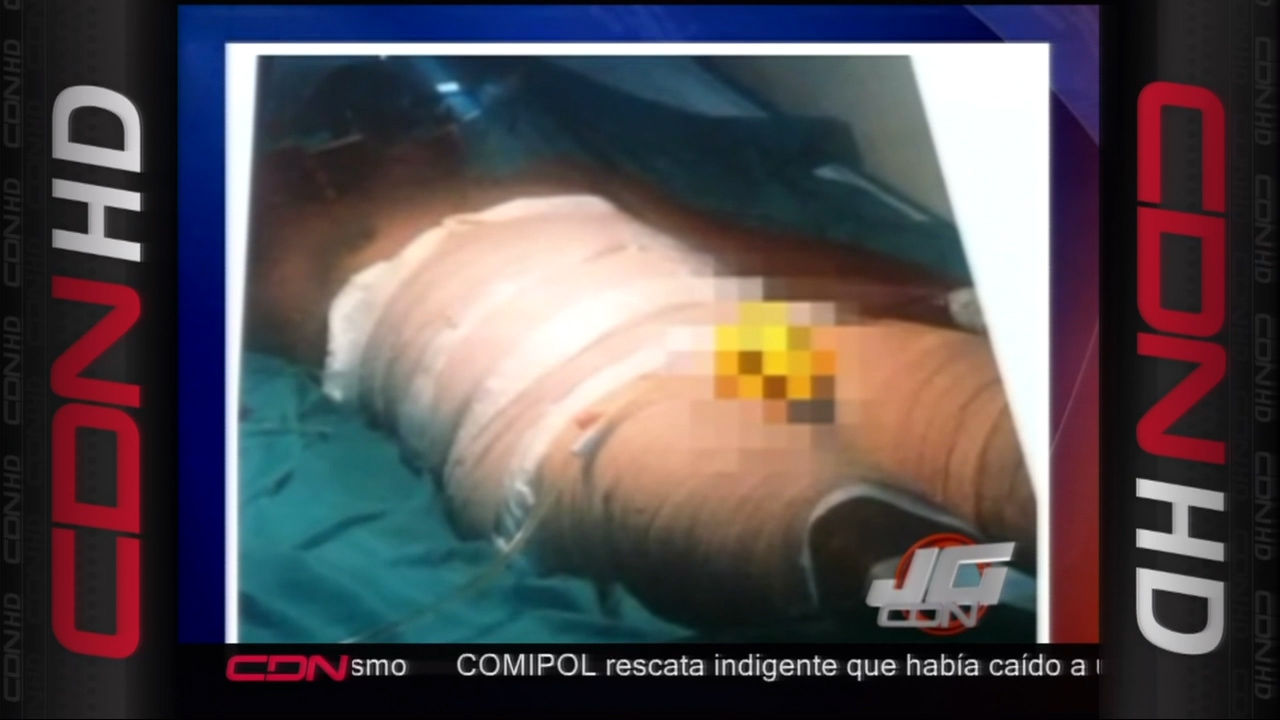 La Policía Apresa A Señora Acusada De Causar Quemaduras A Su Ex Pareja