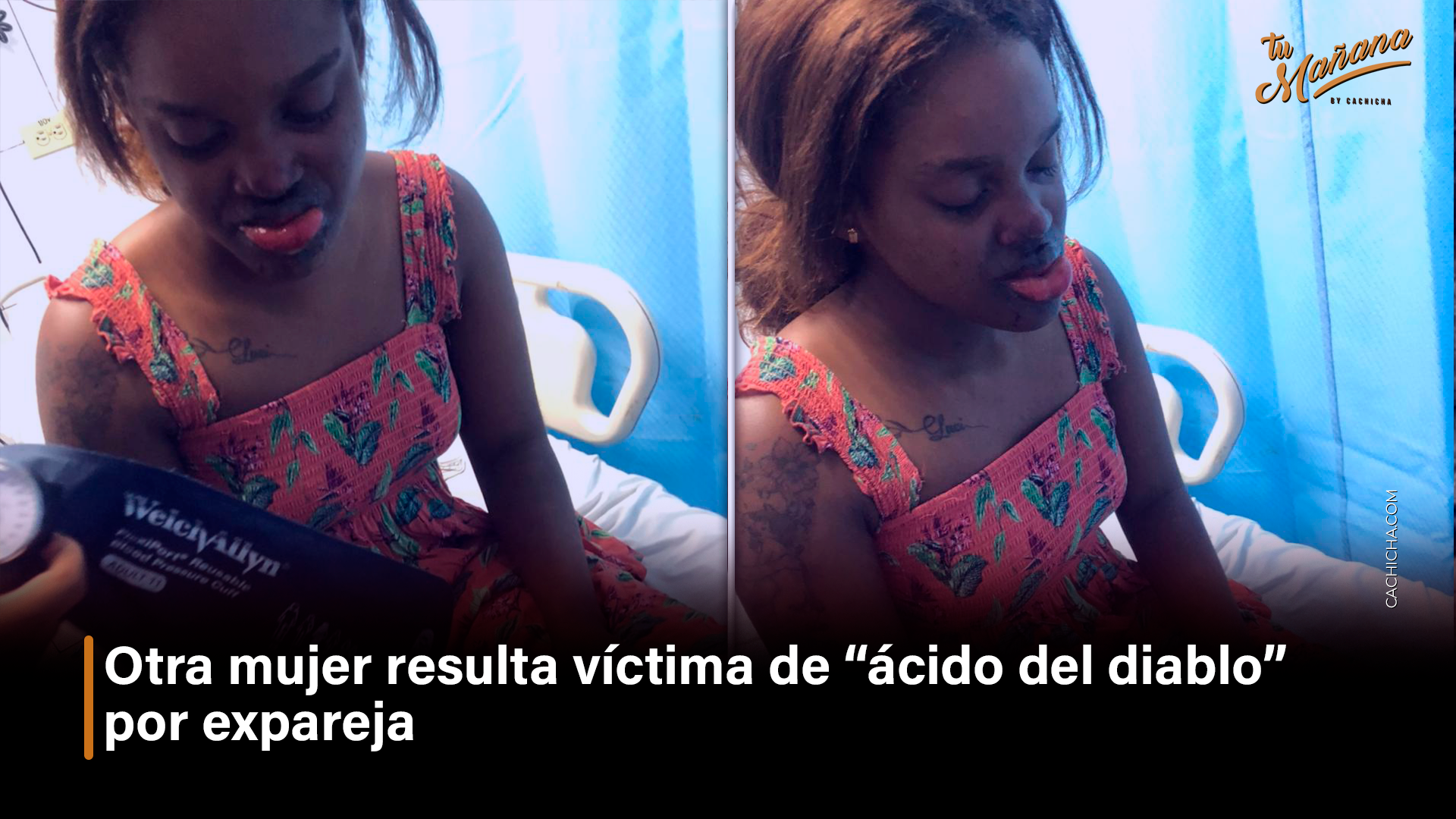 Otra Mujer Resulta Víctima De “ácido Del Diablo” Por Expareja  – Tu Mañana By Cachicha