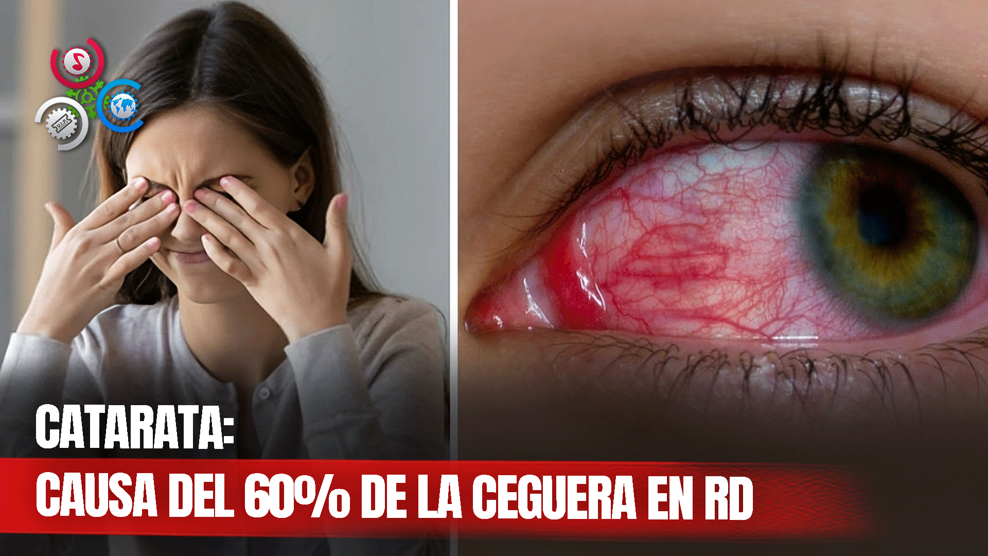 La Catarata: Causa De La Ceguera En Un 60% Actualmente