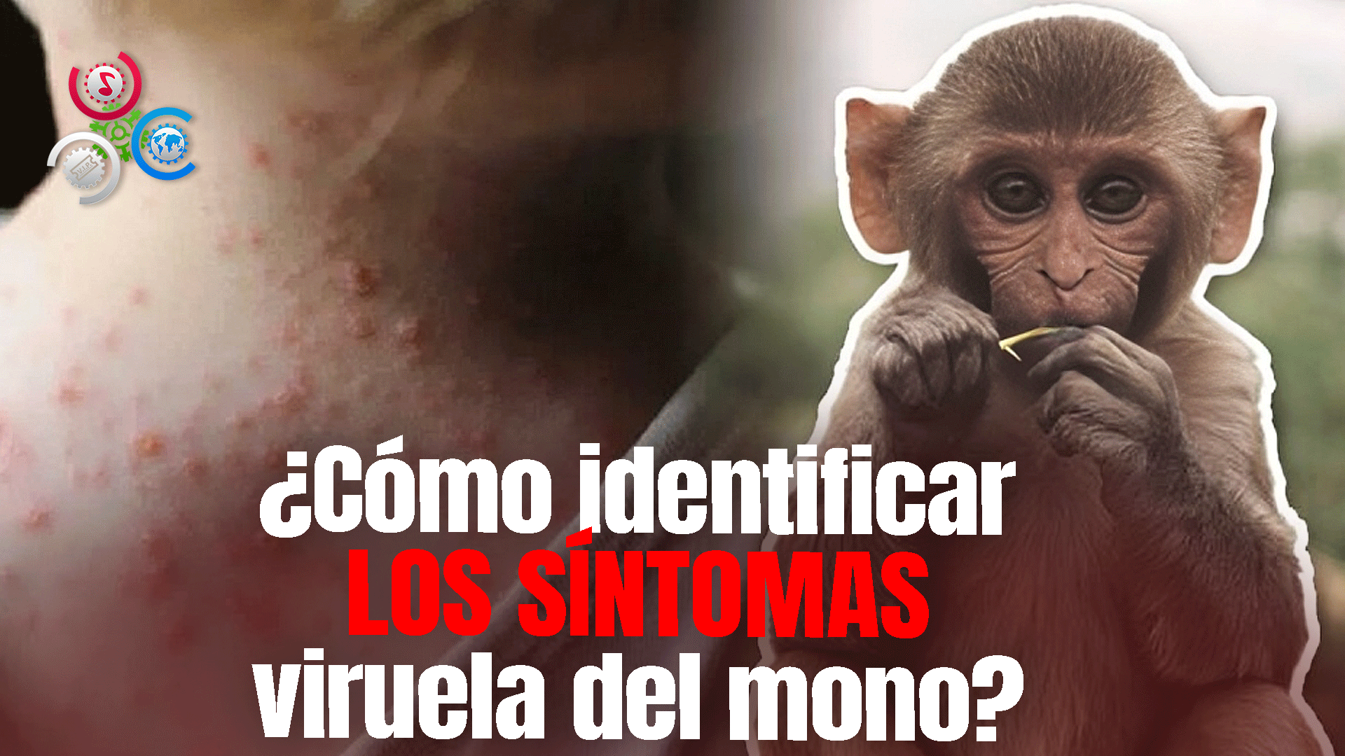 ¿Cuáles Son Los Principales Síntomas Para Detectar La Viruela Del Mono?
