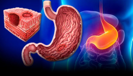 Gastroenterólogo Especialista Nos Explica Las Diferentes Causas De La Úlcera Péptica
