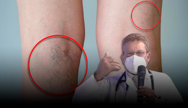 ¿Cómo Se Producen Y Por Qué Tenemos Que Cuidarnos De Las Varices? Con El Dr. Santiago Núñez