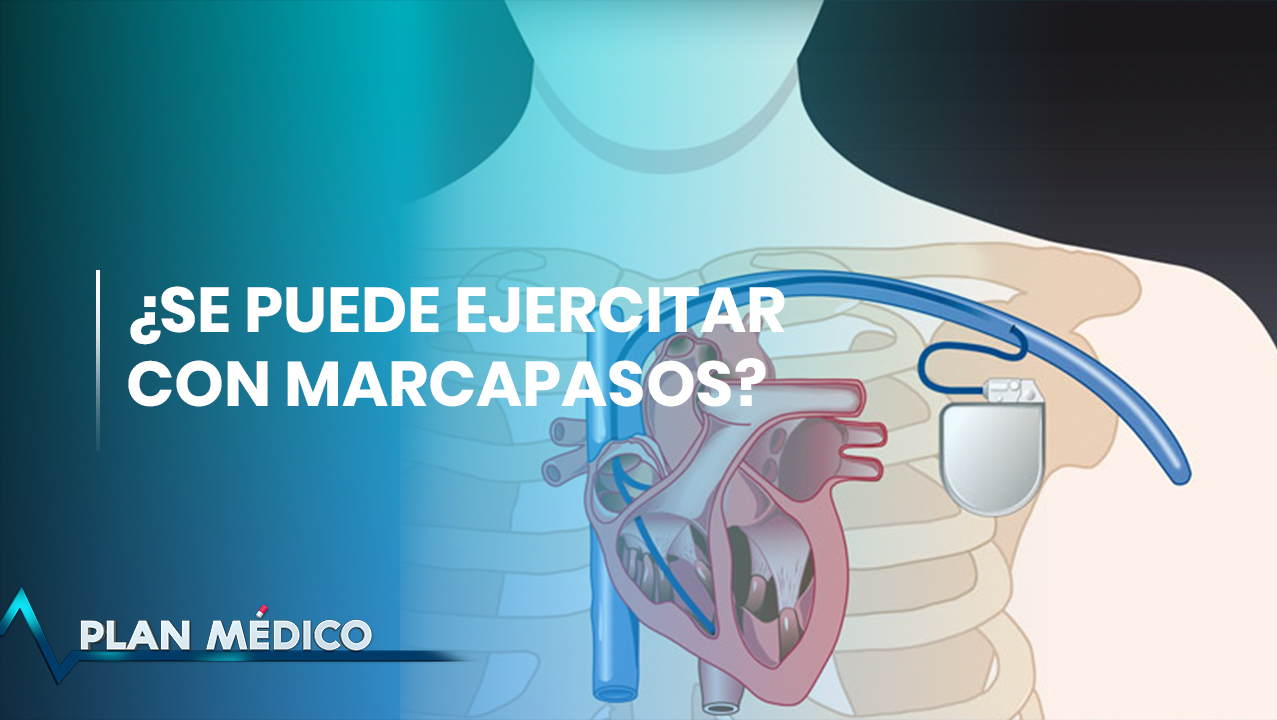 Marcapasos: Equipo Que Salva Vidas | Plan Médico (2/2)