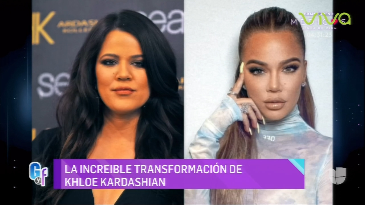 Especialistas Dan A Conocer Detalles Sobre La Transformación De Khloe Kardashian