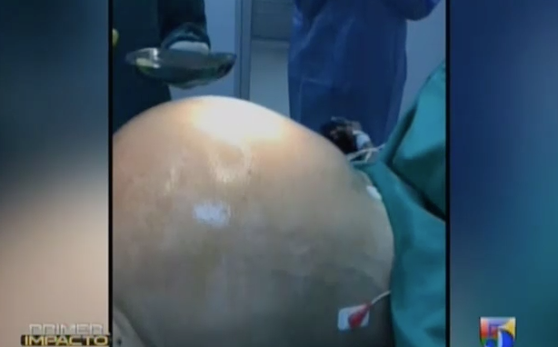 Extraen Tumor De 37 Libras Que Cargaba Una Mujer Durante 3 Años #Video