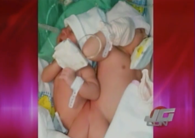 Nacen Siamesas En Moca Y Se Encuentran En Estado Delicado De Salud #Video