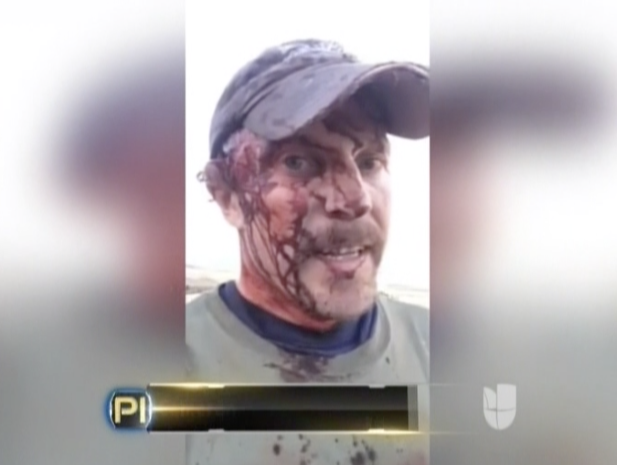Este Hombre Fue Atacado Por Un Oso Y Se Grabo En Un Video Después De Sobrevivir