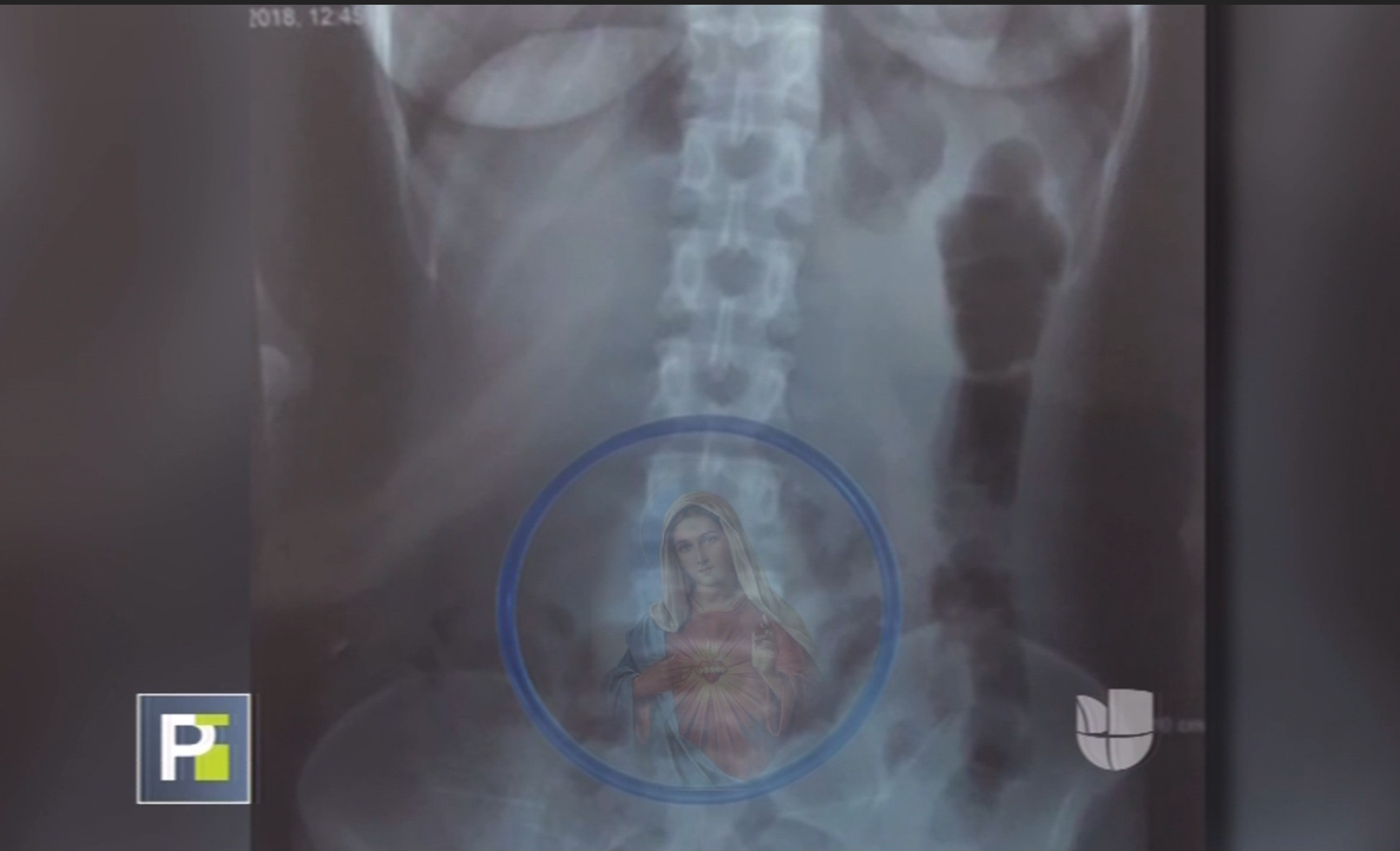 Mujer Llega Con Un Dolor En El Vientre Al Hospital Y Mira Lo Que Le Encontraron