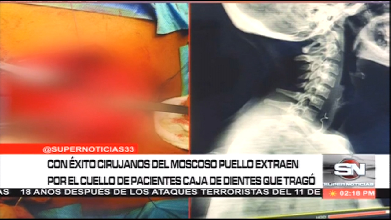 Cirujanos Extraen Por El Cuello Caja De Dientes Que Se Tragó Una Paciente