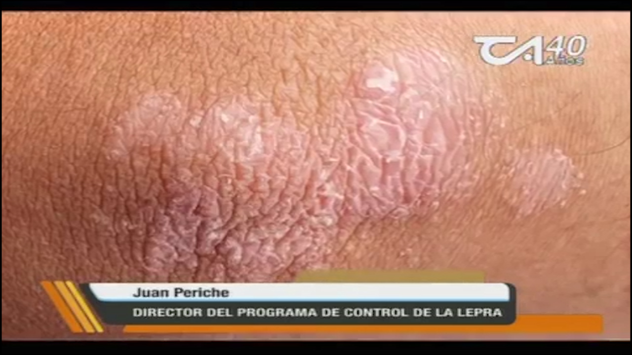 La Psoriasis, Inflamación De La Piel Que Es Desconocida, Pero No Es Contagiosa
