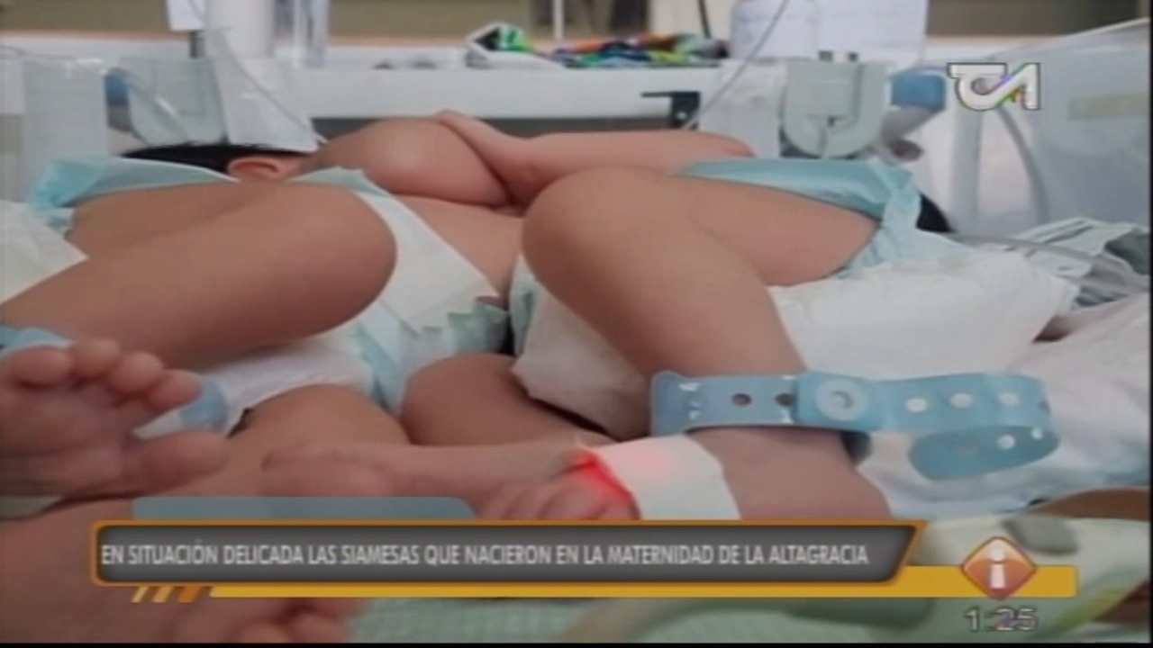 Se Encuentran En Una Situación Delicada Las Siamesas Que Nacieron En La Maternidad De La Altagracia
