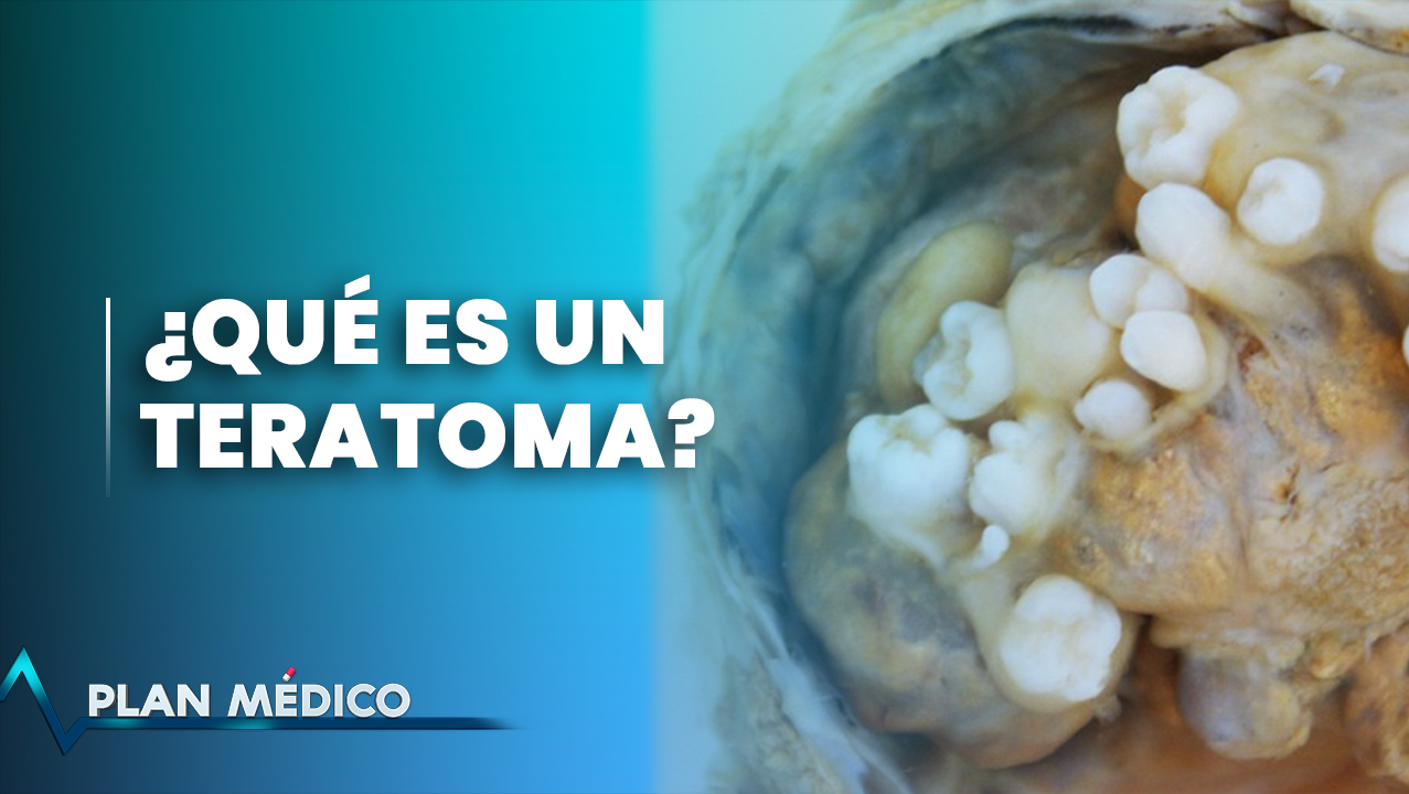 Teratoma De Ovarios | Plan Médico (1/2)