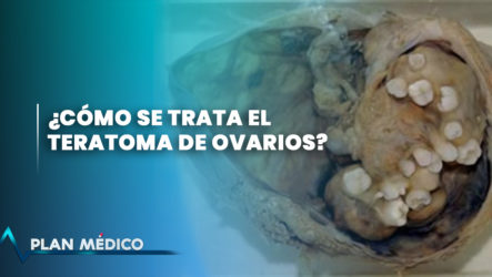 Teratoma De Ovarios | Plan Médico (2/2)