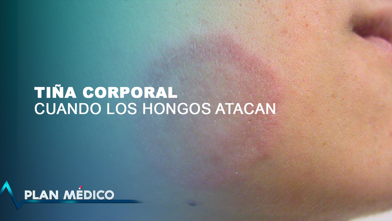 La Tiña Corporal: Cuando Los Hongos Atacan | Plan Médico