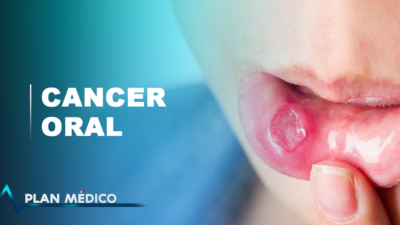 EN VIVO: Cáncer Oral En República Dominicana | Plan Médico
