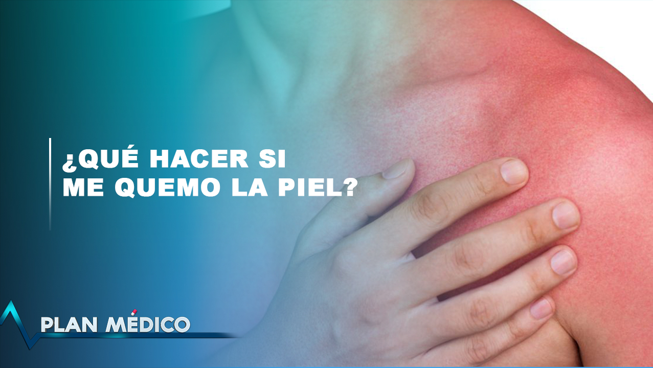 ¿Qué Hacer Si Me Quemo La Piel? 2/2 | Plan Médico
