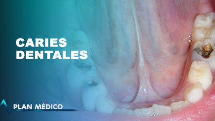 Las Caries Dentales Y Qué Las Produce | Plan Médico
