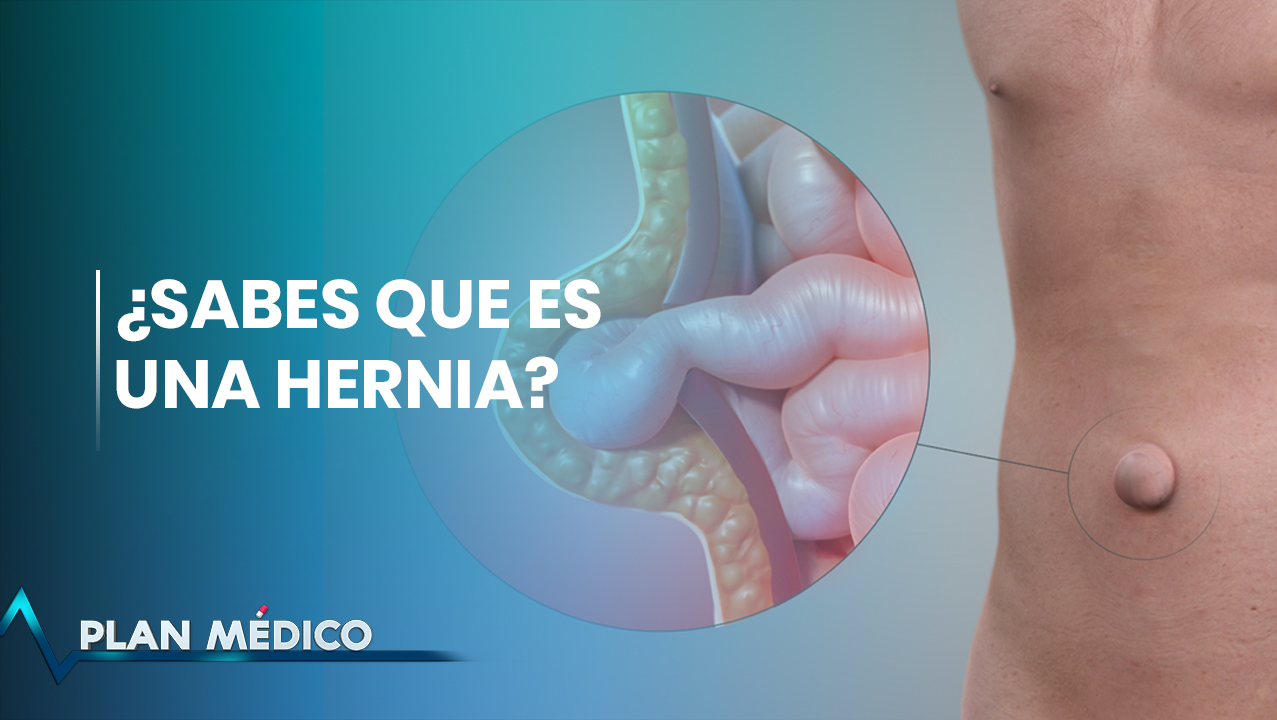 EN VIVO: ¿Sabes Que Es Una Hernia? | Plan Médico
