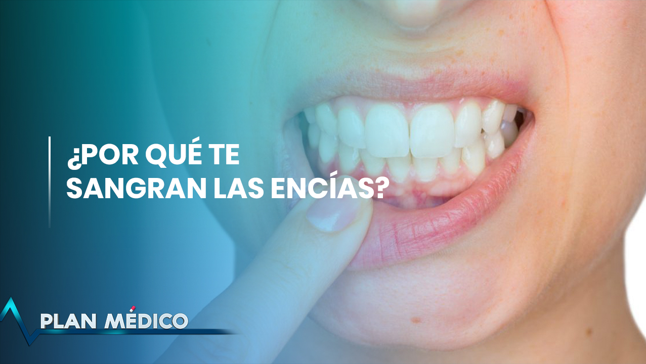 ¿Por Qué Te Sangran Las Encías? | Plan Médico