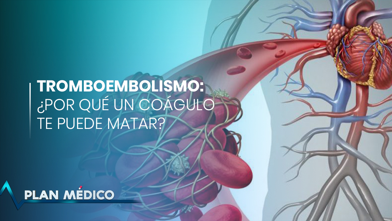 EN VIVO: Tromboembolismo: ¿Por Qué Un Coágulo De Sangre Te Puede Matar? | Plan Médico
