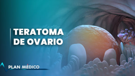 EN VIVO: Teratoma De Ovarios | Plan Médico