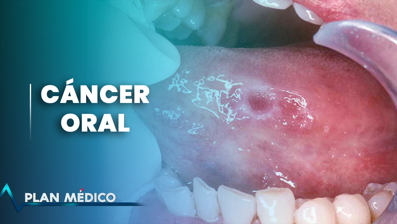 EN VIVO: Cáncer Oral | Plan Médico