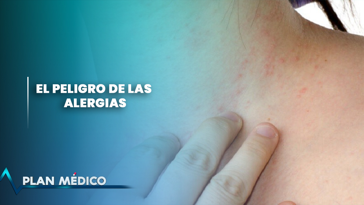 ¿Qué Tan Peligrosas Son Las Alergias? | Plan Médico (1/2)