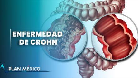 Enfermedad De Crohn | Plan Médico