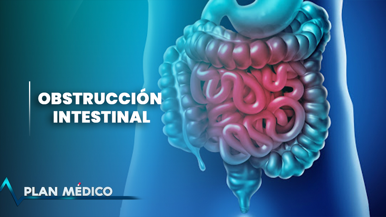 EN VIVO: Obstrucción Intestinal | Plan Médico