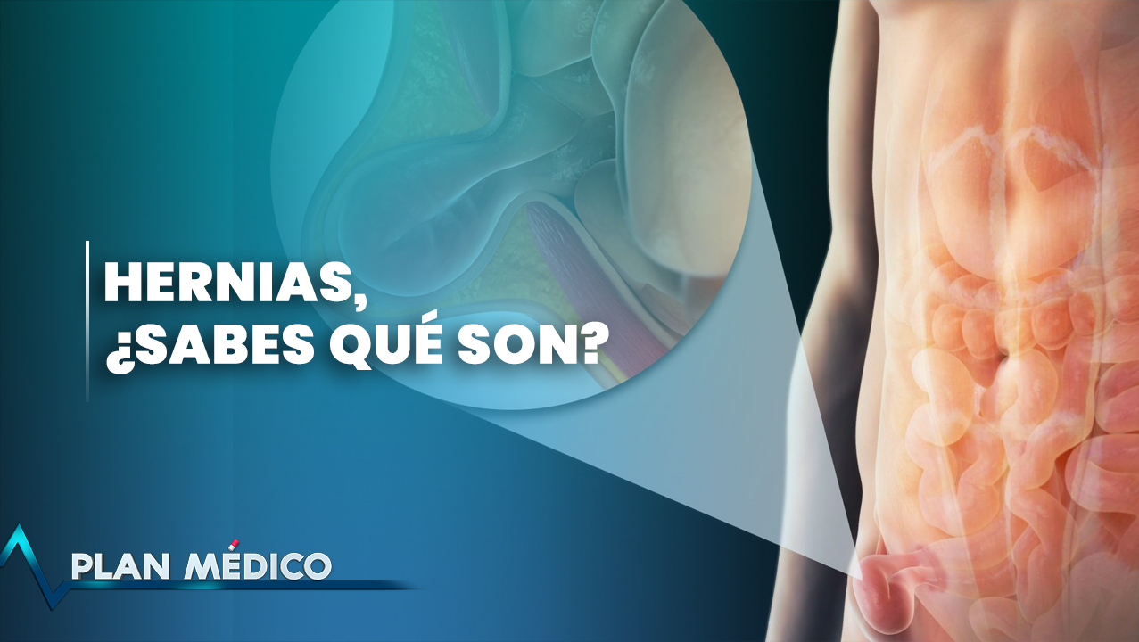 Hernias ¿sabes Qué Son? | Plan Médico