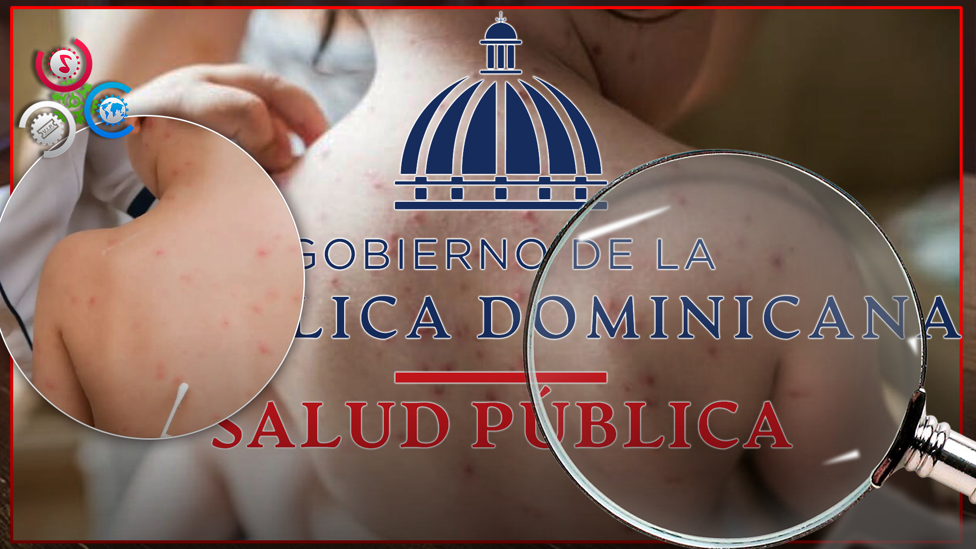 Un Brote De Varicela Obliga Cierre De Un Colegio En El Distrito Nacional