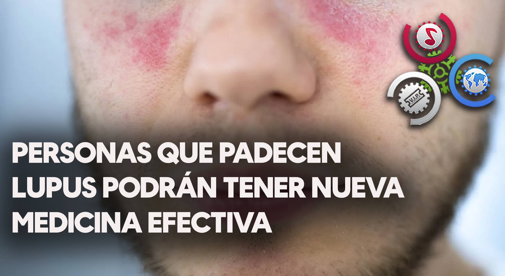 Un Revolucionario Tratamiento Podrá Ayudar A Las Personas Que Padecen Lupus A Tener Nueva Medicina Efectiva