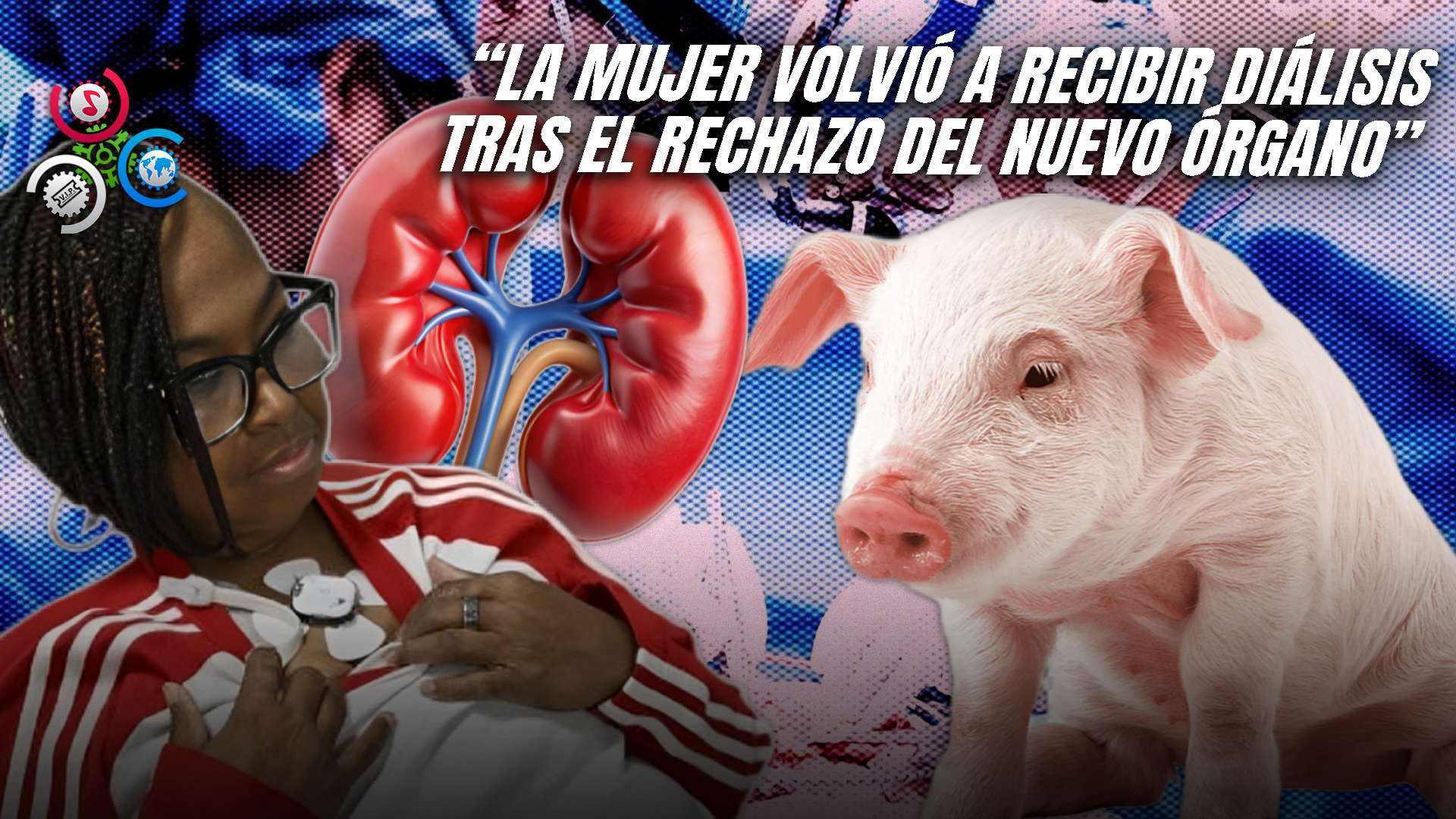 Primera Mujer En Vivir Más De Cuatro Meses Con Riñón De Cerdo Trasplantado