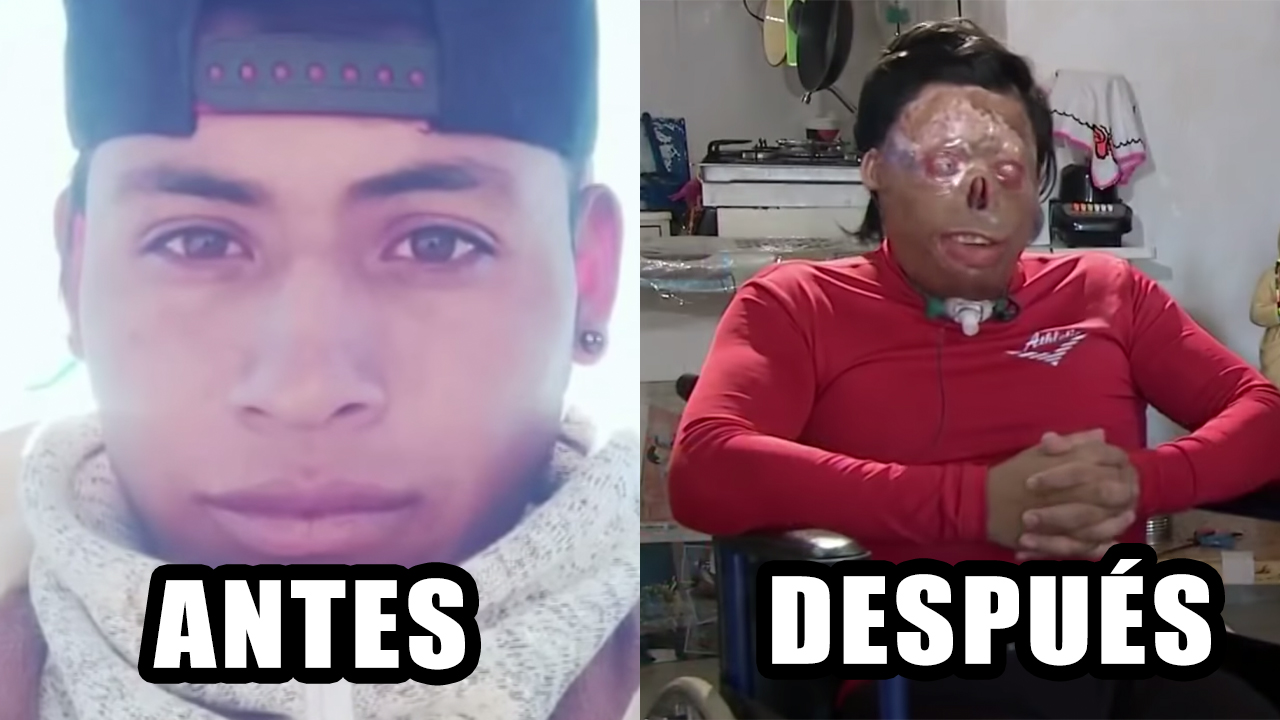 “Quiero Un Rostro Para Buscar A Mi Hijo”: El Anhelo De Este Hombre Que Sufrió Quemaduras