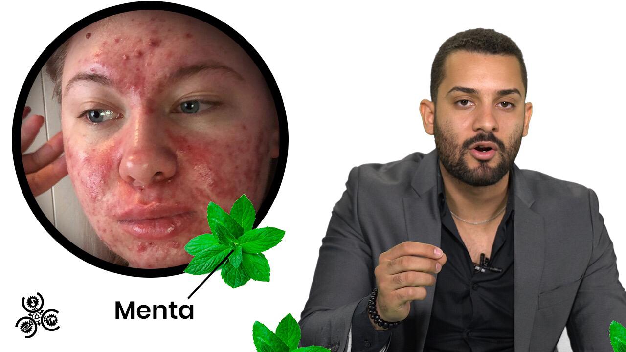 5 Remedios Casero Para El Acné | Disfrutar Aprendiendo