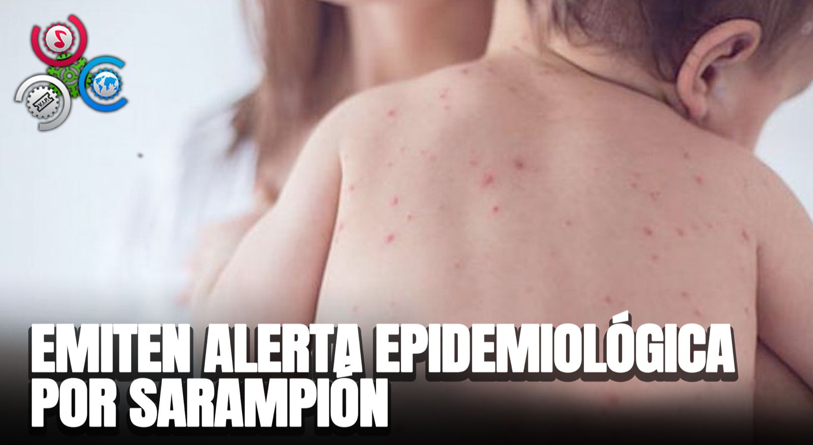 Salud Pública Emite Alerta Epidemiológica Por Sarampión