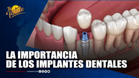 La Importancia De Los Implantes Dentales | Tu Tarde