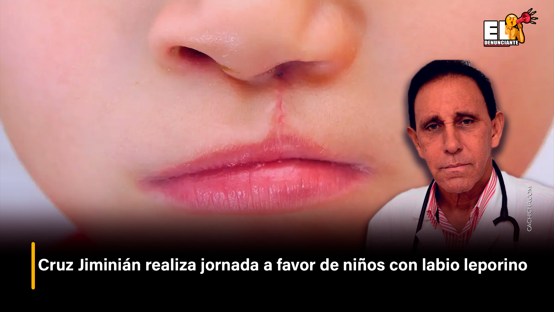 Cruz Jiminián Realiza Jornada A Favor De Niños Con Labio Leporino – El Denunciante By Cachicha