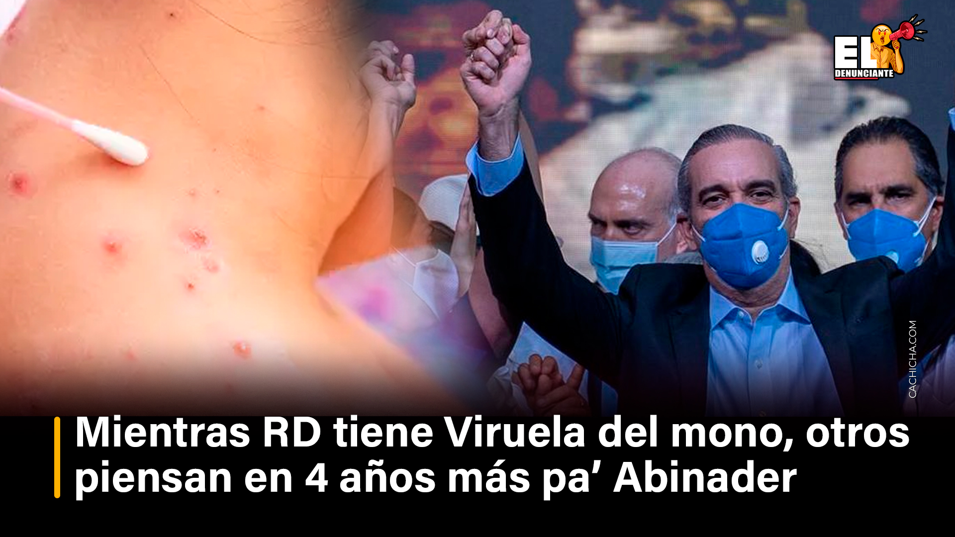 RD Con Viruela Del Mono, Y Gente Pensando En 4 Años Más Pa’ Abinader