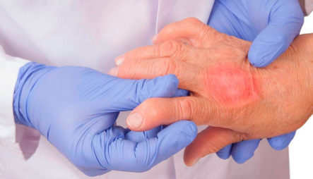 Conociendo Que Es La Artritis Psoriásica