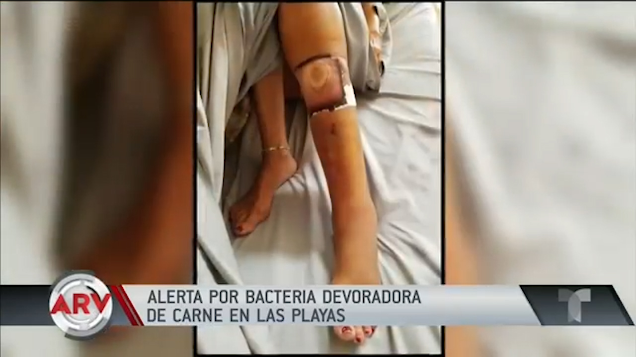 Alerta Por Bacteria Devoradora De Carne En La Playas De EEUU