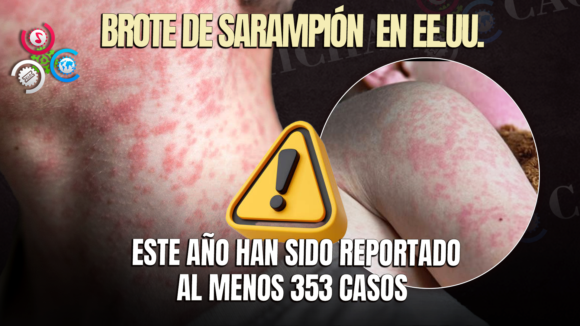 Estados Unidos Enfrenta Un Preocupante Brote De Sarampión Tras Años De Erradicación