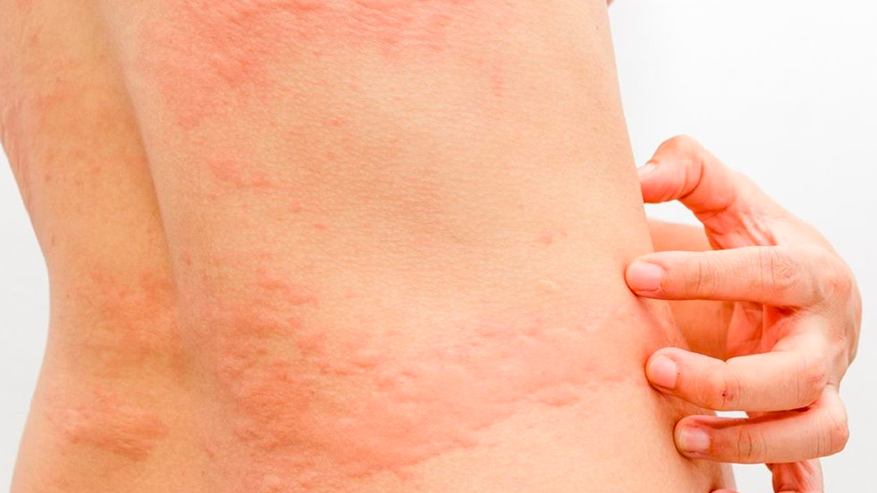 Aclara Cuáles Cambios En La Piel Podrían Ser Síntomas Del COVID-19