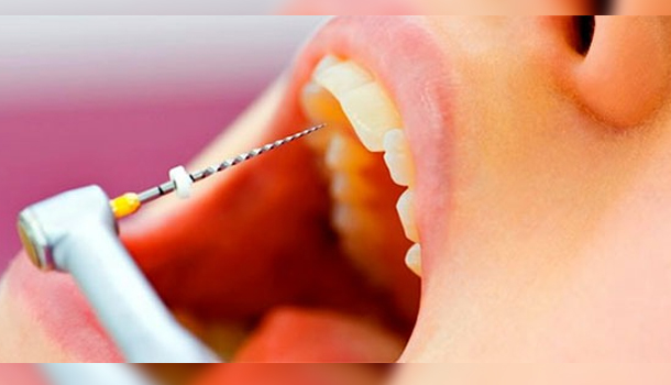 ¿Qué Son Los Tratamientos De Canal?