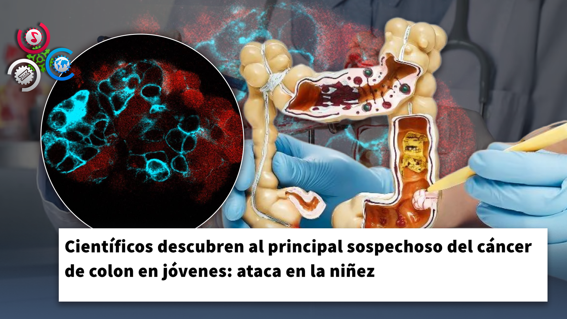 Descubren Posible Causa Del Aumento Del Cáncer Colorrectal En Jóvenes
