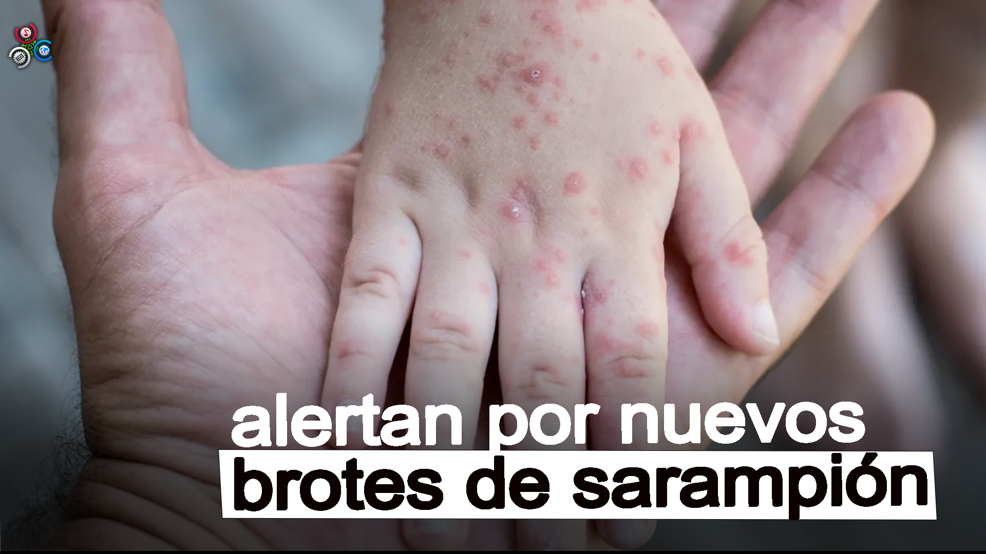 Los CDC Alertan Por Nuevos Brotes De Sarampión Entre Niños Y Adolescentes