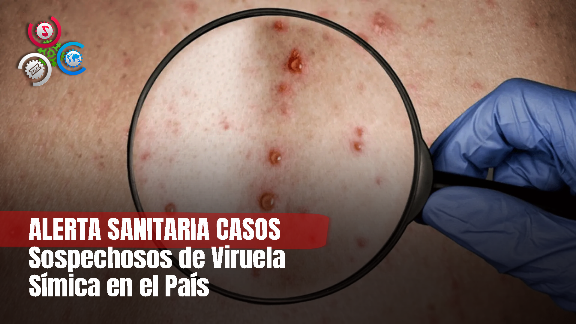 MSP Confirma Hay 6 Casos Sospechosos De Viruela Sísmica