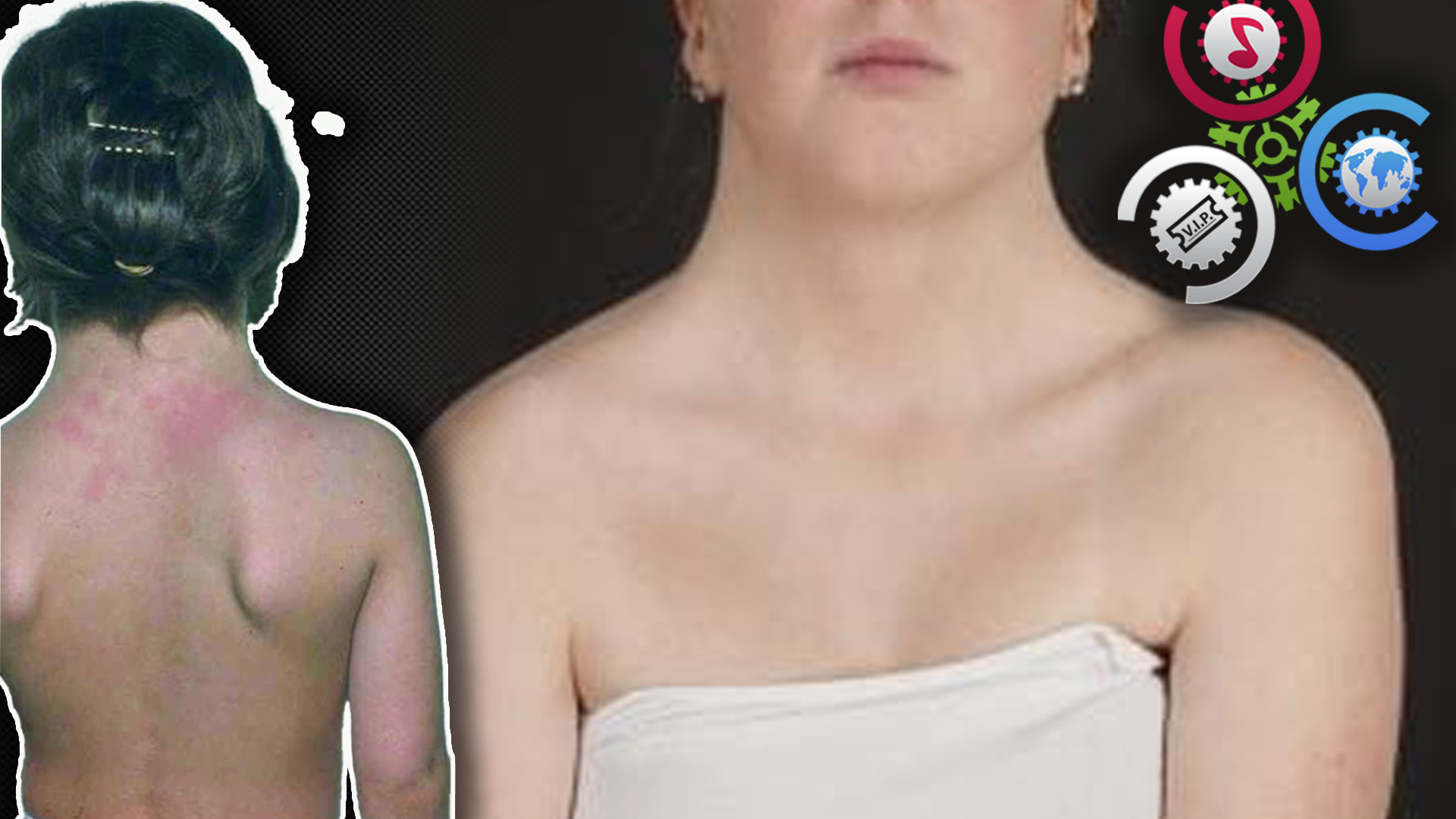 Día Mundial Del Síndrome De Turner: Claves Para Entender Una Enfermedad Que Afecta Sólo A Las Mujeres